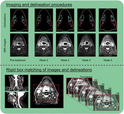 MRI visibility and displacement of elective lymph nodes during radiotherapy in head and neck cancer patients